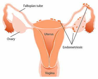 endometriosis_diag