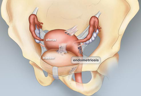 webmd_rf_photo_of_illustration_of_endometriosis